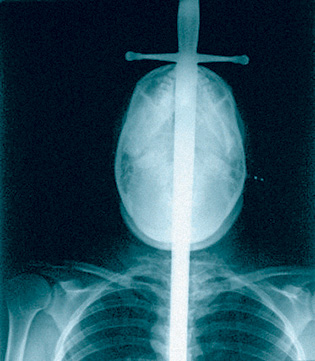 Рентген шпагоглотателя