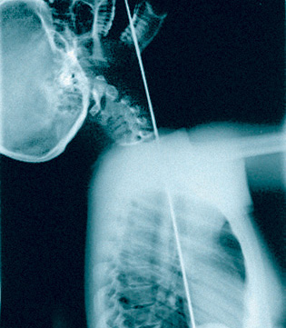Рентгеновский снимок шпагоглотателя