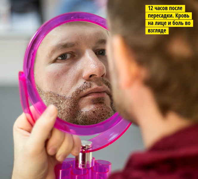 Пересадка бороды Пересадка бороды