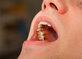 Напасть: как выпрямить кривые зубы
