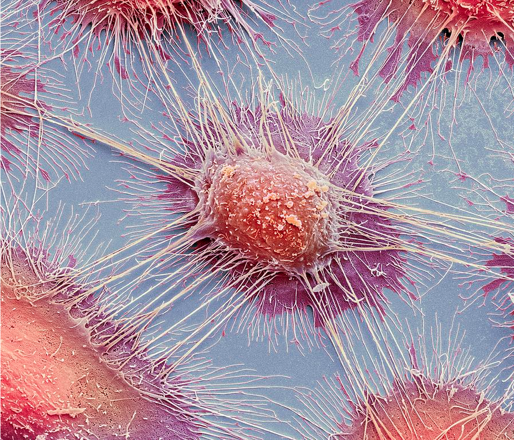 Раковые клетки через микроскоп