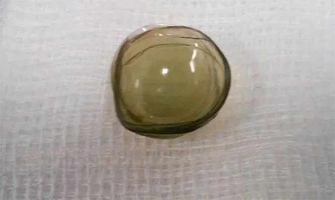 Самый страшный кошмар всех, кто носит контактные линзы, реализовался! Самый страшный кошмар всех, кто носит контактные линзы, реализовался!